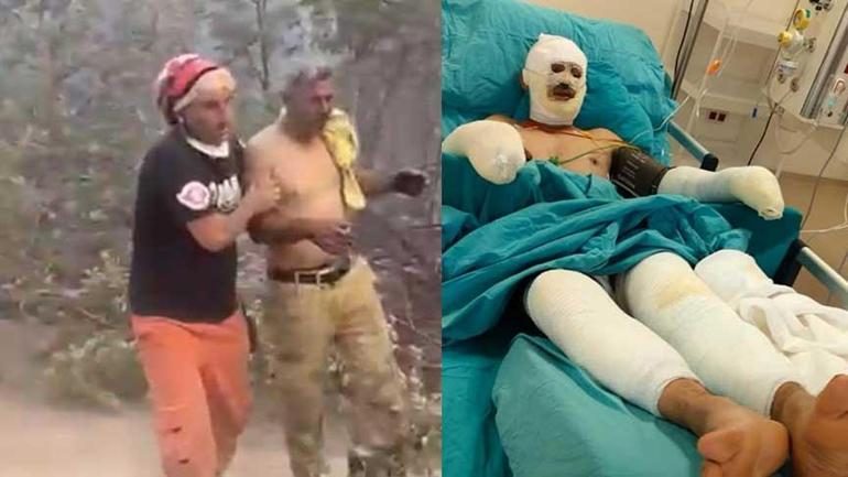 Türkiye onu bu görüntüyle tanıdı Yangında ağır yaralanan orman işçisinin son hali...